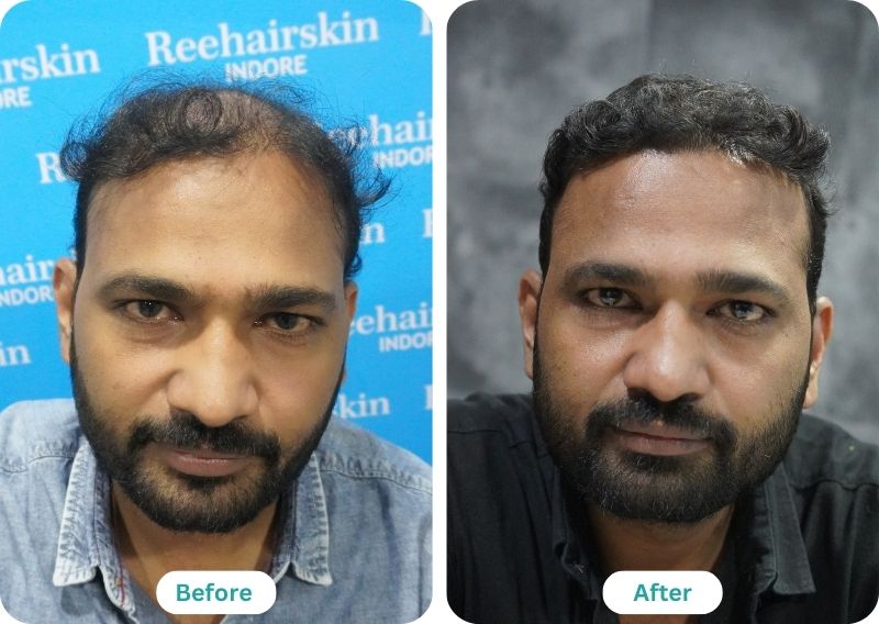 Hair Transplant result before and after